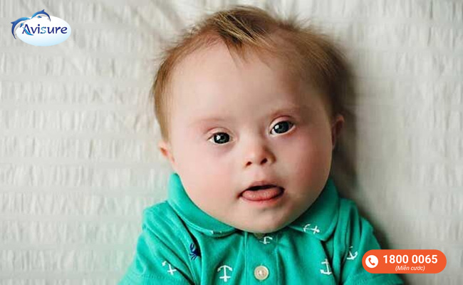 Trẻ sinh ra bị mắc hội chứng Down