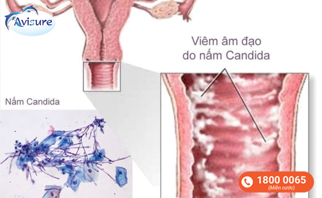 Phụ nữ mang thai thường bị viêm âm đạo do nấm Candida