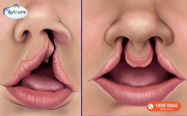 Hở hàm ếch hay sứt môi là dị tật thai nhi thường gặp